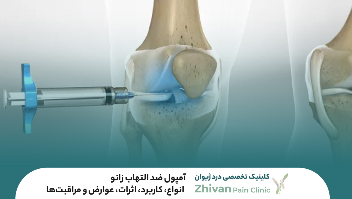 آمپول ضد التهاب زانو – انواع، کاربرد، اثرات، عوارض و مراقبت‌ها